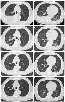 Recurrent Pneumonia With Tuberculosis and Candida Co-infection Diagnosed by Metagenomic Next-Generation Sequencing: A Case Report and Literature Review